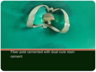 ROOT CANAL PROCEDURE.pdf