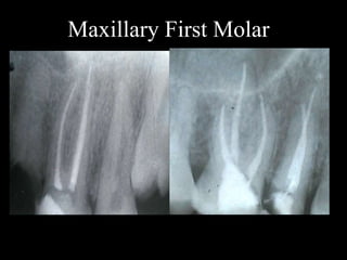 Maxillary Tooth Roots Root canals morphology and configurations - maxillary teeth | PPTX