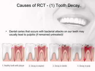 Causes of RCT - (1) Tooth Decay
• Dental caries that occurs with bacterial attacks on our teeth may
usually lead to pulpitis (if remained untreated)!
 
