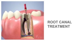 ROOT CANAL
TREATMENT
 