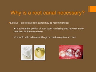 Why is a root canal necessary?
Elective – an elective root canal may be recommended:

    If a substantial portion of your tooth is missing and requires more
    retention for the new crown

    If a tooth with extensive fillings or cracks requires a crown
 