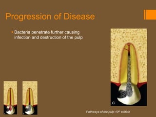 Progression of Disease
  Bacteria penetrate further causing
   infection and destruction of the pulp




                                           Pathways of the pulp 10th edition
 