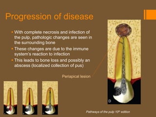 Progression of disease
  With complete necrosis and infection of
   the pulp, pathologic changes are seen in
   the surrounding bone
  These changes are due to the immune
   system’s reaction to infection
  This leads to bone loss and possibly an
   abscess (localized collection of pus)

                           Periapical lesion




                                         Pathways of the pulp 10th edition
 