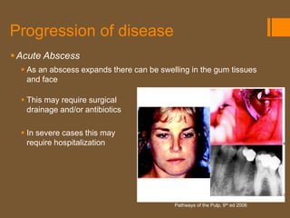 Progression of disease
 Acute Abscess
   As an abscess expands there can be swelling in the gum tissues
    and face

   This may require surgical
    drainage and/or antibiotics

   In severe cases this may
    require hospitalization




                                           Pathways of the Pulp, 9th ed 2006
 