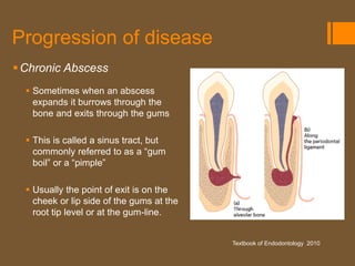 Progression of disease
 Chronic Abscess
   Sometimes when an abscess
    expands it burrows through the
    bone and exits through the gums

   This is called a sinus tract, but
    commonly referred to as a “gum
    boil” or a “pimple”

   Usually the point of exit is on the
    cheek or lip side of the gums at the
    root tip level or at the gum-line.


                                           Textbook of Endodontology 2010
 