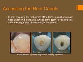 Accessing the Root Canals
  To gain access to the root canals of the tooth, a small opening is
   made either on the chewing surface of the tooth (for back teeth),
   or on the tongue side of the tooth (for front teeth).




            Upper anterior tooth showing access opening into canal
 