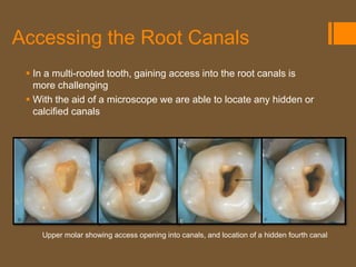 Accessing the Root Canals
  In a multi-rooted tooth, gaining access into the root canals is
   more challenging
  With the aid of a microscope we are able to locate any hidden or
   calcified canals




    Upper molar showing access opening into canals, and location of a hidden fourth canal
 