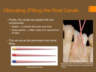 Obturating (Filling) the Root Canals
  Finally, the canals are sealed with two
   components:
    Sealer – a cement that sets over time
    Gutta percha – a filler made of a natural form
     of latex


  This serves as the permanent root canal
   filling




                                                      Resected bone and root from a mandibular
                                                      molar showing placement of gutta percha
                   Gutta percha cones                 cones
 