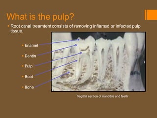 What is the pulp?
 Root canal treamtent consists of removing inflamed or infected pulp
  tissue.


        Enamel

        Dentin

        Pulp

        Root

        Bone

                                    Sagittal section of mandible and teeth
 