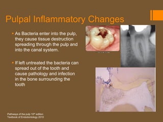 Pulpal Inflammatory Changes
     As Bacteria enter into the pulp,
      they cause tissue destruction
      spreading through the pulp and
      into the canal system.

     If left untreated the bacteria can
      spread out of the tooth and
      cause pathology and infection
      in the bone surrounding the
      tooth




Pathways of the pulp 10th edition
Textbook of Endodontology 2010
 