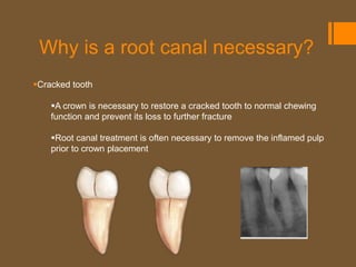 Why is a root canal necessary?
Cracked tooth

    A crown is necessary to restore a cracked tooth to normal chewing
    function and prevent its loss to further fracture

    Root canal treatment is often necessary to remove the inflamed pulp
    prior to crown placement
 