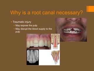Why is a root canal necessary?
 Traumatic injury
   May expose the pulp
   May disrupt the blood supply to the
    pulp
 