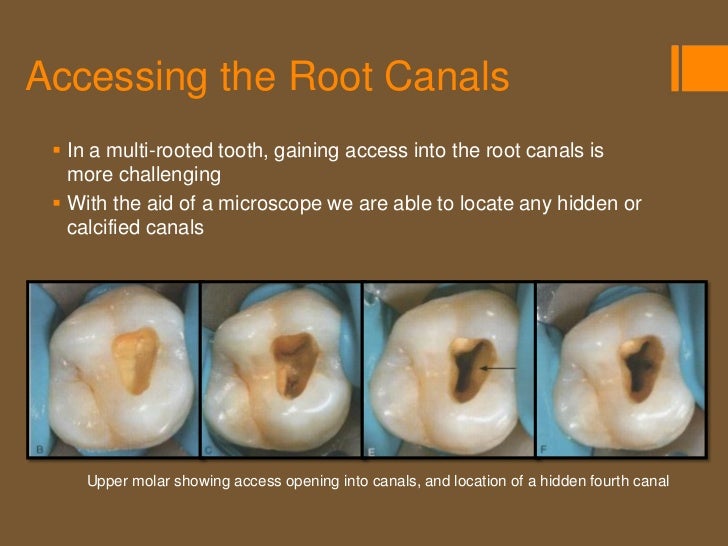molar root canals