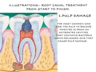 ILLUSTRATIONS:- ROOT CANAL TREATMENT FROM START TO FINISH. 1.PULP DAMAGE THE MOST COMMON WAY FOR THE PULP TO BECOME INFECTED IS FROM AN UNTREATES CAVITIES  THAT CONTAINS BACTERIA WHICH RELEASES ACID.THAT CAUSE PULP DAMAGE.  