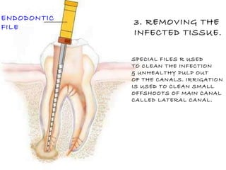 3. REMOVING THE  INFECTED TISSUE. SPECIAL FILES R USED TO CLEAN THE INFECTION & UNHEALTHY PULP OUT  OF THE CANALS. IRRIGATION IS USED TO CLEAN SMALL  OFFSHOOTS OF MAIN CANAL CALLED LATERAL CANAL. ENDODONTIC FILE 