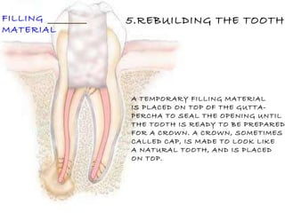 FILLING MATERIAL 5.REBUILDING THE TOOTH A TEMPORARY FILLING MATERIAL IS PLACED ON TOP OF THE GUTTA- PERCHA TO SEAL THE OPENING UNTIL THE TOOTH IS READY TO BE PREPARED FOR A CROWN. A CROWN, SOMETIMES CALLED CAP, IS MADE TO LOOK LIKE A NATURAL TOOTH, AND IS PLACED ON TOP. 
