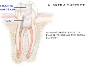 FILLING MATERIAL POST IN SOME CASES, A POST IS  PLACED TO CROWN THE EXTRA  SUPPORT. 6. EXTRA SUPPORT 