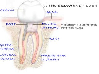 CROWN FILLING ,ATERIAL BONE LATERAL CANALS GUTTA- PERCHA POST PERIODONTAL LIGAMENT GUMS 7. THE CROWNING TOUCH THE CROWN IS CEMENTED  INTO THE PLACE. 