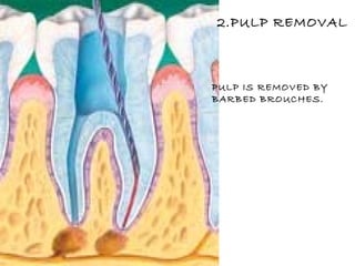 2.PULP REMOVAL PULP IS REMOVED BY BARBED BROUCHES. 