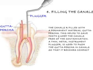 PLUGGER GUTTA- PERCHA 4. FILLING THE CANALS. THE CANALS R FILLED WITH A PERMANENT MATERIAL GUTTA- PERCHA. THIS HELPS TO SAVE TOOTH & KEEP THE CANALS FREE OF THE CONTAMINATION. A THIN, METAL INSTRUMENT PLUGGER, IS USED TO PUSH  THE GUTTA-PERCHA IN CANALS SO THAT IT BECOMES COMPACT 