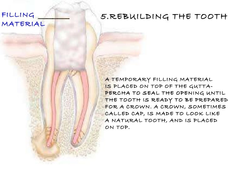 Root Canal Treatment