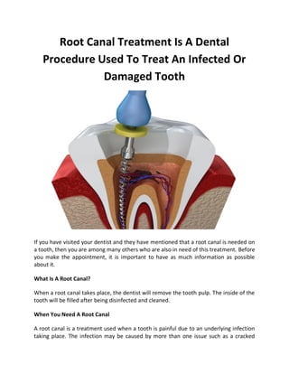 Root Canal Treatment Is A Dental
Procedure Used To Treat An Infected Or
Damaged Tooth
If you have visited your dentist and they have mentioned that a root canal is needed on
a tooth, then you are among many others who are also in need of this treatment. Before
you make the appointment, it is important to have as much information as possible
about it.
What Is A Root Canal?
When a root canal takes place, the dentist will remove the tooth pulp. The inside of the
tooth will be filled after being disinfected and cleaned.
When You Need A Root Canal
A root canal is a treatment used when a tooth is painful due to an underlying infection
taking place. The infection may be caused by more than one issue such as a cracked
 