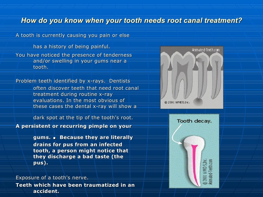 Root canal treatment slides