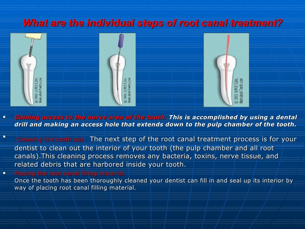 Root canal treatment slides
