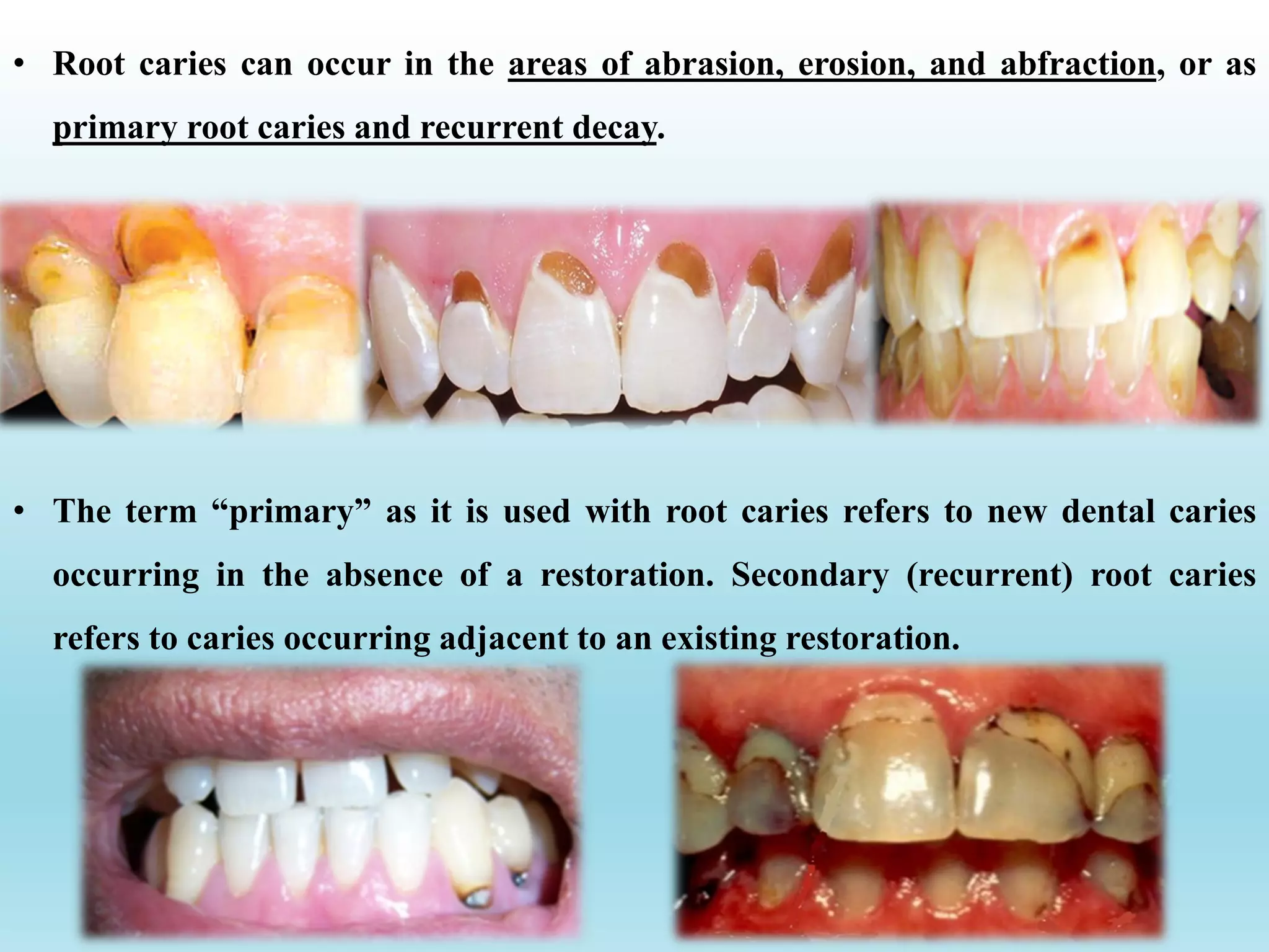 • The term “primary” as it is used with root caries refers to new dental caries
occurring in the absence of a restoration. Secondary (recurrent) root caries
refers to caries occurring adjacent to an existing restoration.
• Root caries can occur in the areas of abrasion, erosion, and abfraction, or as
primary root caries and recurrent decay.
 