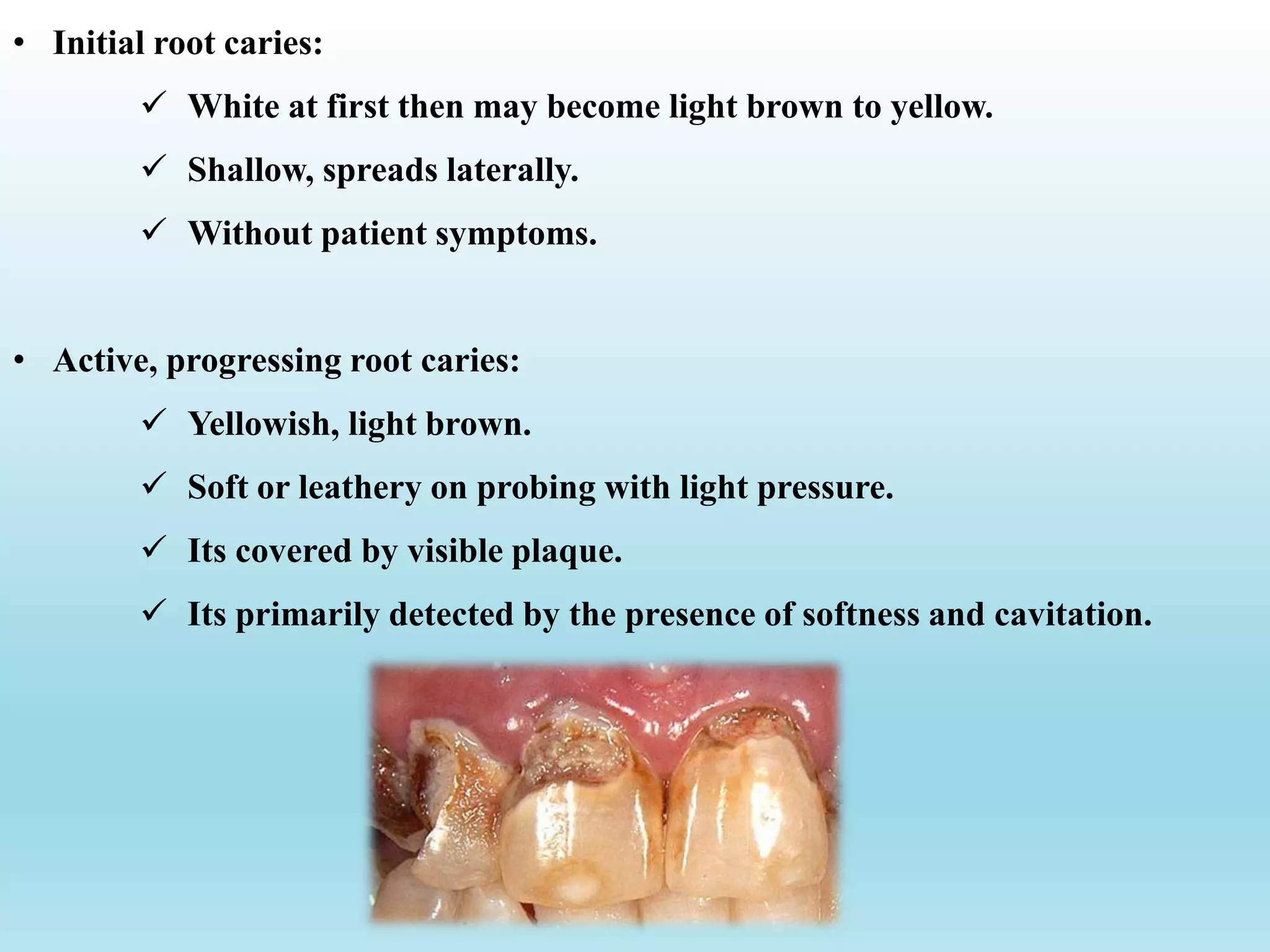 • Initial root caries:
 White at first then may become light brown to yellow.
 Shallow, spreads laterally.
 Without patient symptoms.
• Active, progressing root caries:
 Yellowish, light brown.
 Soft or leathery on probing with light pressure.
 Its covered by visible plaque.
 Its primarily detected by the presence of softness and cavitation.
 