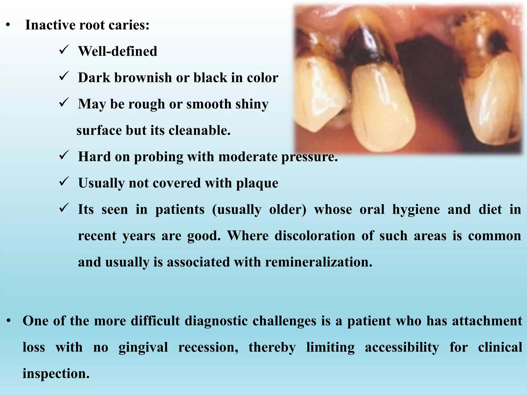 • One of the more difficult diagnostic challenges is a patient who has attachment
loss with no gingival recession, thereby limiting accessibility for clinical
inspection.
• Inactive root caries:
 Well-defined
 Dark brownish or black in color
 May be rough or smooth shiny
surface but its cleanable.
 Hard on probing with moderate pressure.
 Usually not covered with plaque
 Its seen in patients (usually older) whose oral hygiene and diet in
recent years are good. Where discoloration of such areas is common
and usually is associated with remineralization.
 