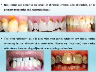 • The term “primary” as it is used with root caries refers to new dental caries
occurring in the absence of a restoration. Secondary (recurrent) root caries
refers to caries occurring adjacent to an existing restoration.
• Root caries can occur in the areas of abrasion, erosion, and abfraction, or as
primary root caries and recurrent decay.
 