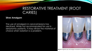 Root caries and class Vclass five tooth.pptx