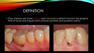 Root caries and class Vclass five tooth.pptx