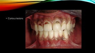 Carious Retained Roots Root caries and class Vclass five tooth.pptx