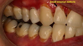 Root caries and class Vclass five tooth.pptx