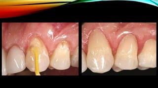 Root caries and class Vclass five tooth.pptx