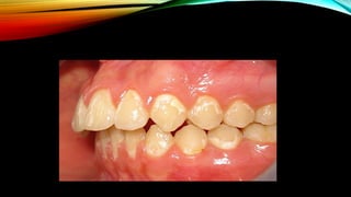 Root caries and class Vclass five tooth.pptx
