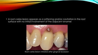 Carious Retained Roots Root caries and class Vclass five tooth.pptx