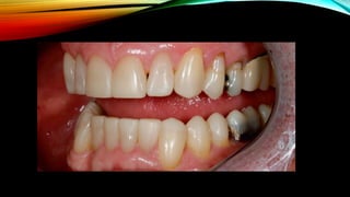 Root caries and class Vclass five tooth.pptx