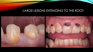 Root caries and class Vclass five tooth.pptx