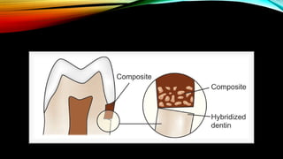 Root caries and class Vclass five tooth.pptx