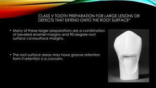 Root caries and class Vclass five tooth.pptx