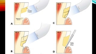 Root caries and class Vclass five tooth.pptx