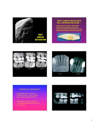 ROOT CARIES PREVALENCE
                                               WILL INCREASE BECAUSE …
                                           •   PROPORTION OF ELDERLY INCREASING
                                           •   TEETH BEING RETAINED LATER IN LIFE
                                           •   GINGIVAL RECESSION INCREASES WITH AGE
                                           •   XEROSTOMIC MEDICATIONS ARE NUMEROUS


                           ROOT
                          SURFACE
                        RESTORATION




8/17/92       11/9/93           12/20/94



                                                  4/15/89                  11/10/90




      CERVICAL BURNOUT
• RADIOGRAPHIC ARTIFACT
  PRODUCED BY A LOCALIZED
  RELATIVE RADIOLUCENCY

• BOUNDED BY CEJ, CREST OF
  ALVEOLAR BONE, LIP LINE, OR
  CALCULUS




                                                                                       1
 