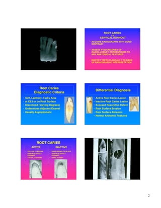 Tacky Normal Root caries restoration.07.ppt