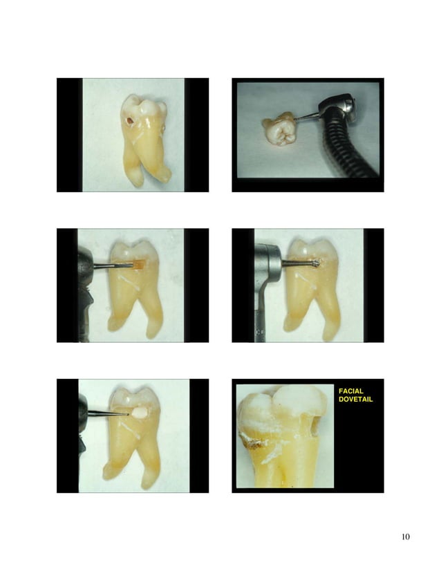 Root caries restoration.07.ppt