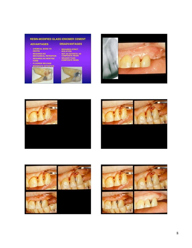 Root caries restoration.07.ppt