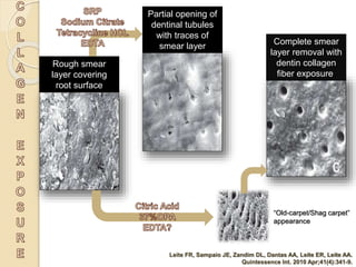 Rough smear
layer covering
root surface
“Old-carpet/Shag carpet”
appearance
Partial opening of
dentinal tubules
with traces of
smear layer
Complete smear
layer removal with
dentin collagen
fiber exposure.
Leite FR, Sampaio JE, Zandim DL, Dantas AA, Leite ER, Leite AA.
Quintessence Int. 2010 Apr;41(4):341-9.
 