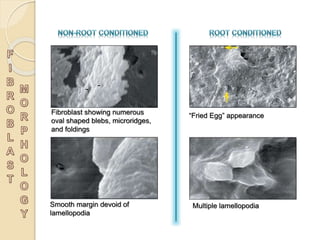 Fibroblast showing numerous
oval shaped blebs, microridges,
and foldings
“Fried Egg” appearance
Smooth margin devoid of
lamellopodia
Multiple lamellopodia
 